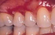 Sepsis in Gums